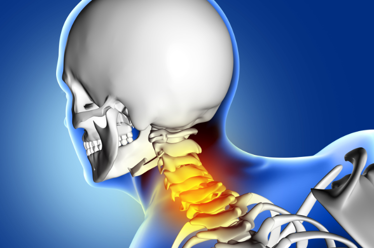Cervical Spine Fixation